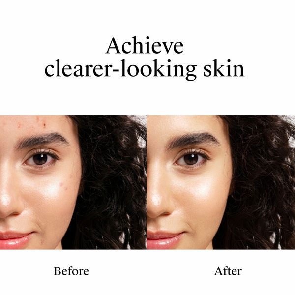 Neutrogena Rapid Clear Stubborn Acne Spot Treatment Gel with Maximum Strength for Acne Prone Skin - 1 oz
